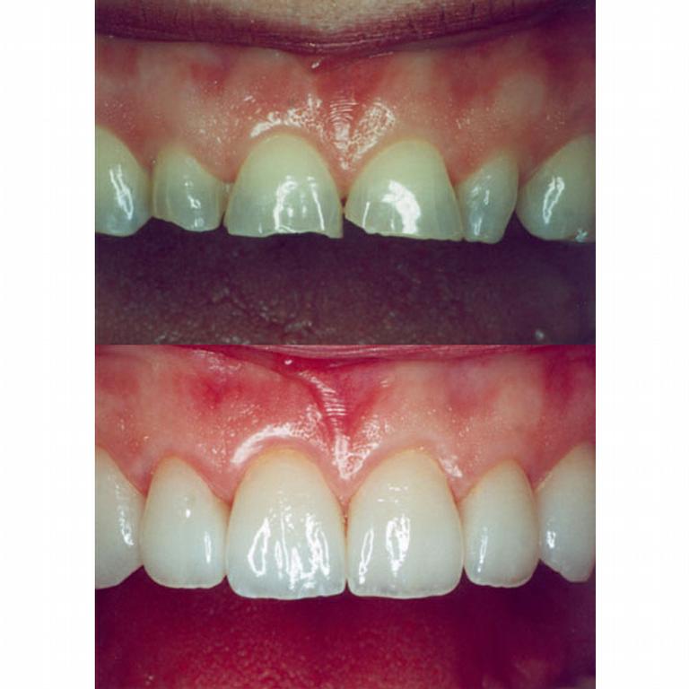 fort lauderdale veneers