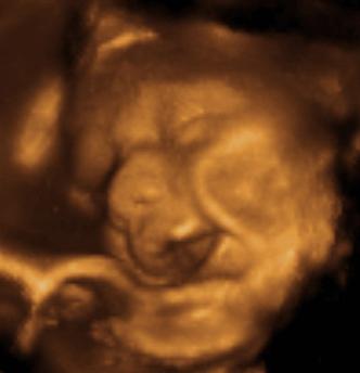 3d fetal ultrasounds