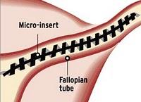 tubalreversal