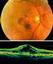 age-related macular degeneration_2.jpg 