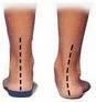 Custom Orthotics Mesa AZ Orthotic Gilbert AZ Custom Orthotics Mesa AZ Orthotic Gilbert AZ