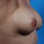 Provided by South Shore Plastic Surgery, Voorhees 