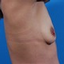 Provided by South Shore Plastic Surgery, Voorhees 
