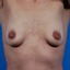 Provided by South Shore Plastic Surgery, Voorhees 