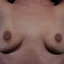 Provided by South Shore Plastic Surgery, Voorhees 