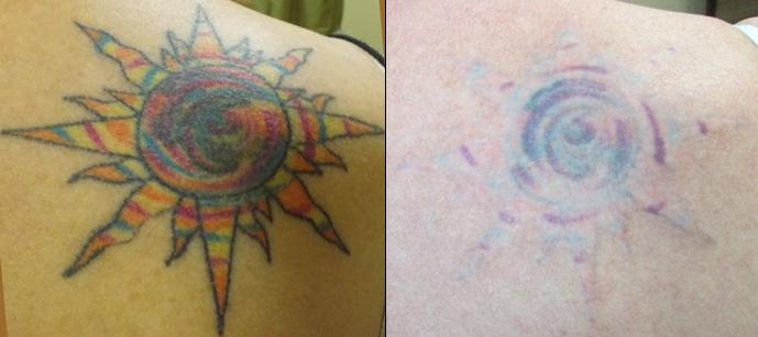 Pictures for Vanish Laser Tattoo Removal and Skin 