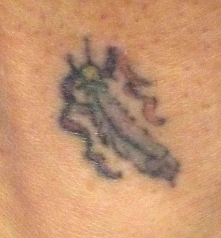 ... tattoo after 1 treatment by Vanish Laser Tattoo Removal and Skin