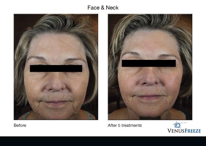 venusfreezebeforeandafters30 by Enhanced Images Medical