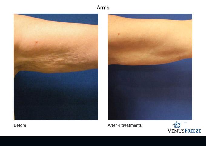 venusfreezebeforeandafters_05 by Enhanced Images Medical