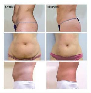 CavitacionBA2.jpg.w300h307 by Lakeside Massage & Spa
