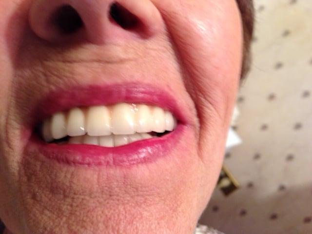 Teeth Whitening Service Florence, SC by Pee Dee Dental Group