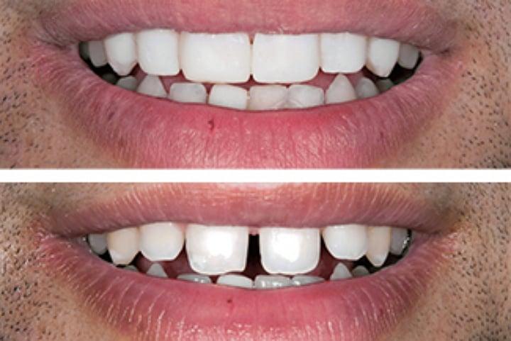 Veneers Florence, SC by Pee Dee Dental Group