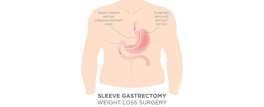  by Gastric Bypass Surgery