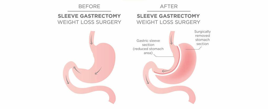  by Gastric Bypass Surgery
