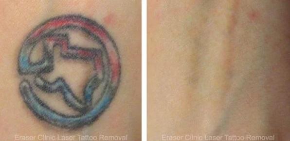  by Eraser Clinic Laser Tattoo Removal