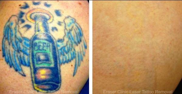  by Eraser Clinic Laser Tattoo Removal