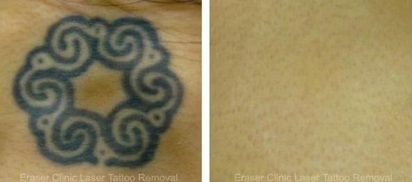  by Eraser Clinic Laser Tattoo Removal