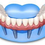  by Dental Implants Wellington