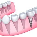  by Dental Implants Wellington